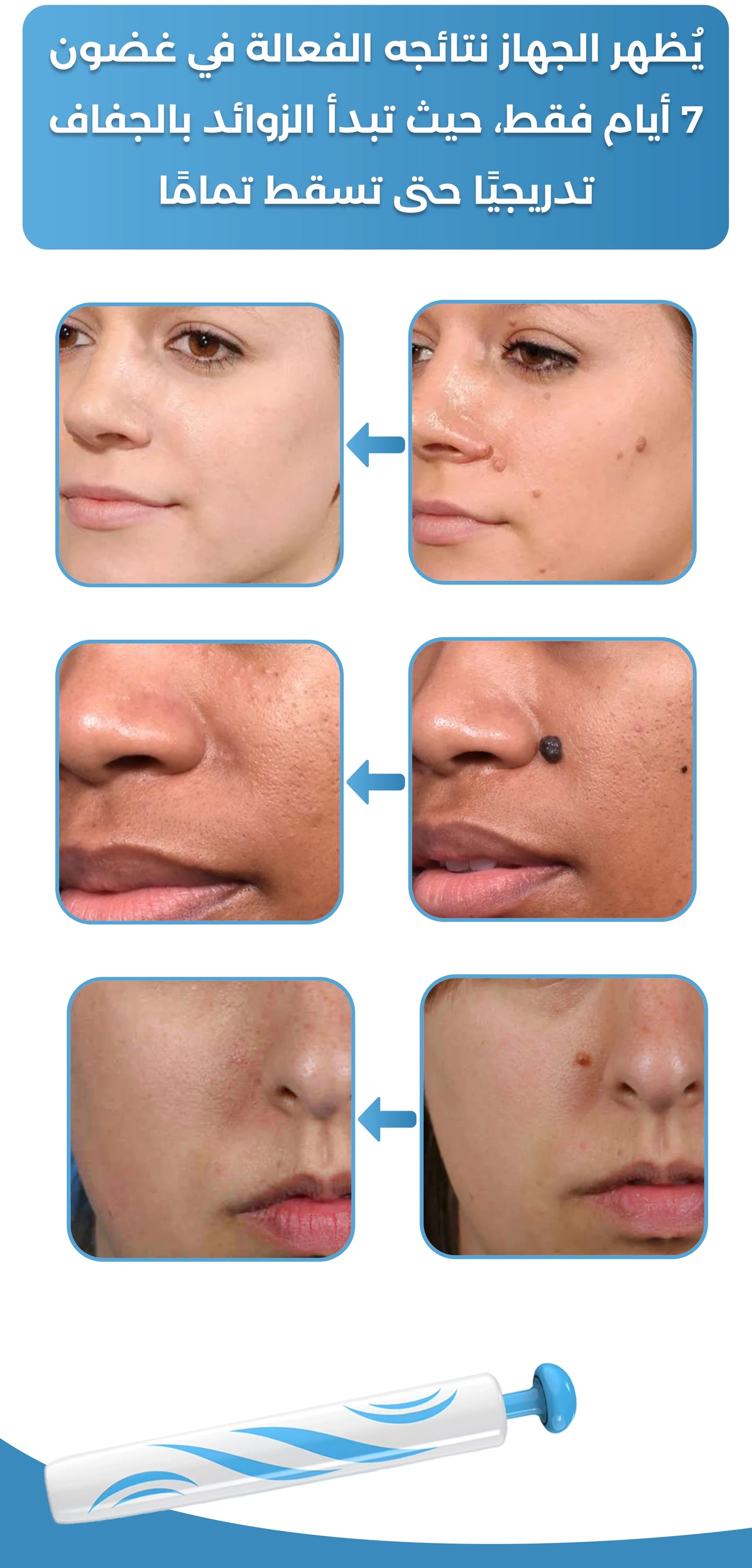 جهاز إزالة الشامات والزوائد الجلدية - بشرة نقية بدون جراحة