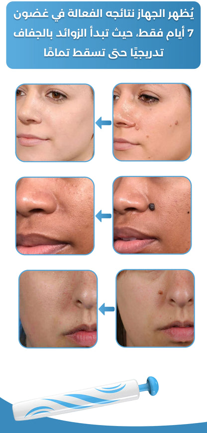 جهاز إزالة الشامات والزوائد الجلدية - بشرة نقية بدون جراحة