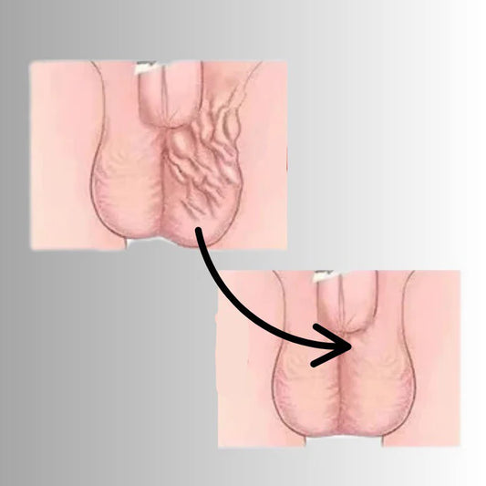 كريم علاج دوالي الخصية